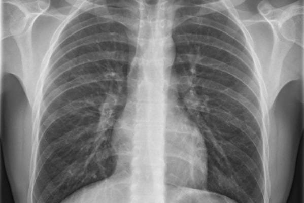 Radiografie, raggi x, polmoni